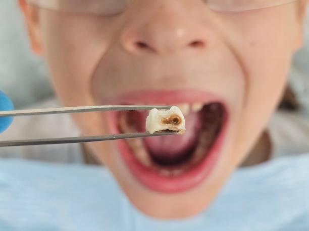 Best Emergency Tooth Extraction in Jefferson, OR